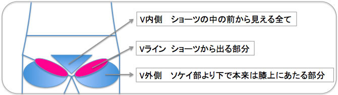 ビキニライン（Vライン）