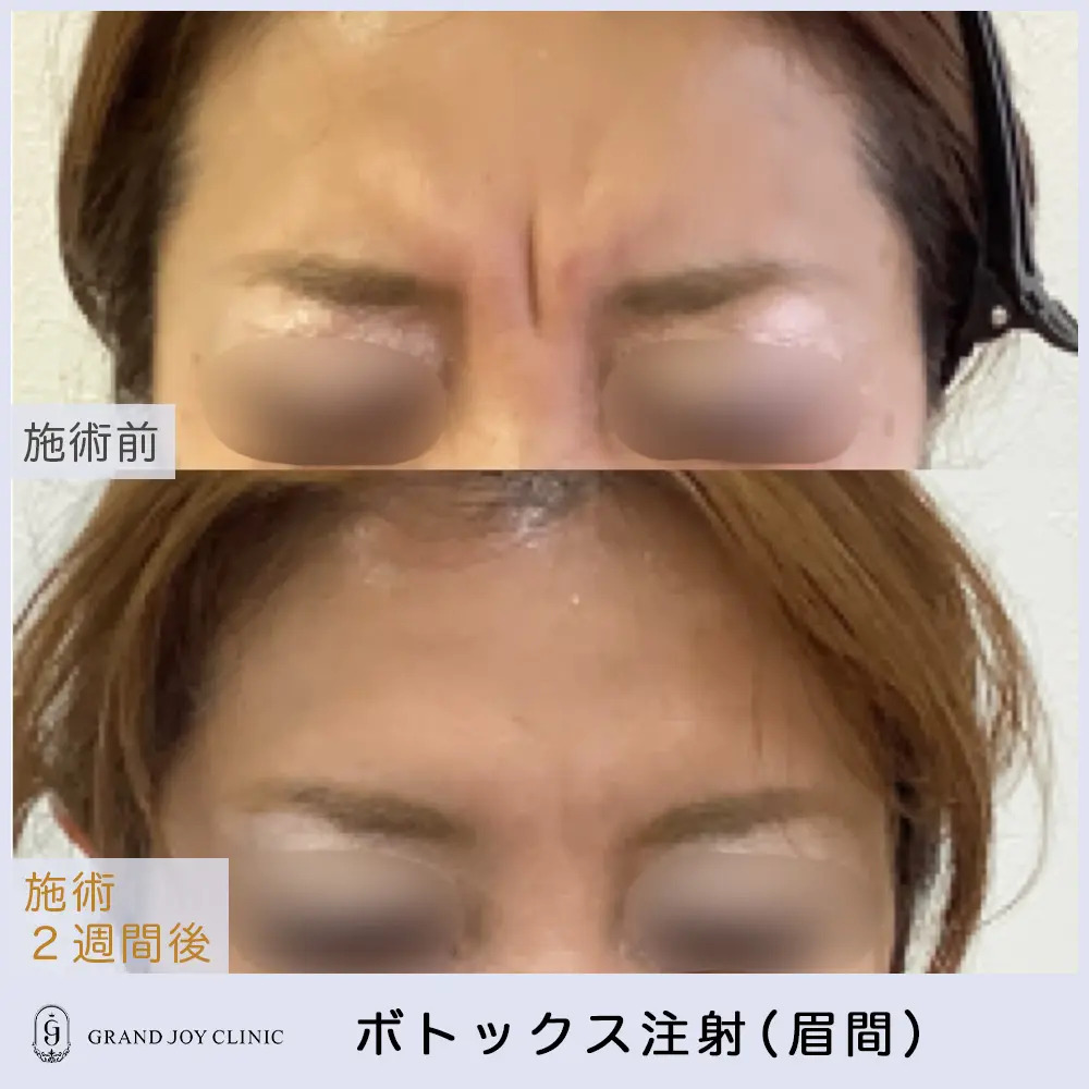 ボトックス症例(眉間)