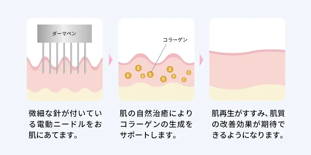 ダーマペンの効果を示した図表