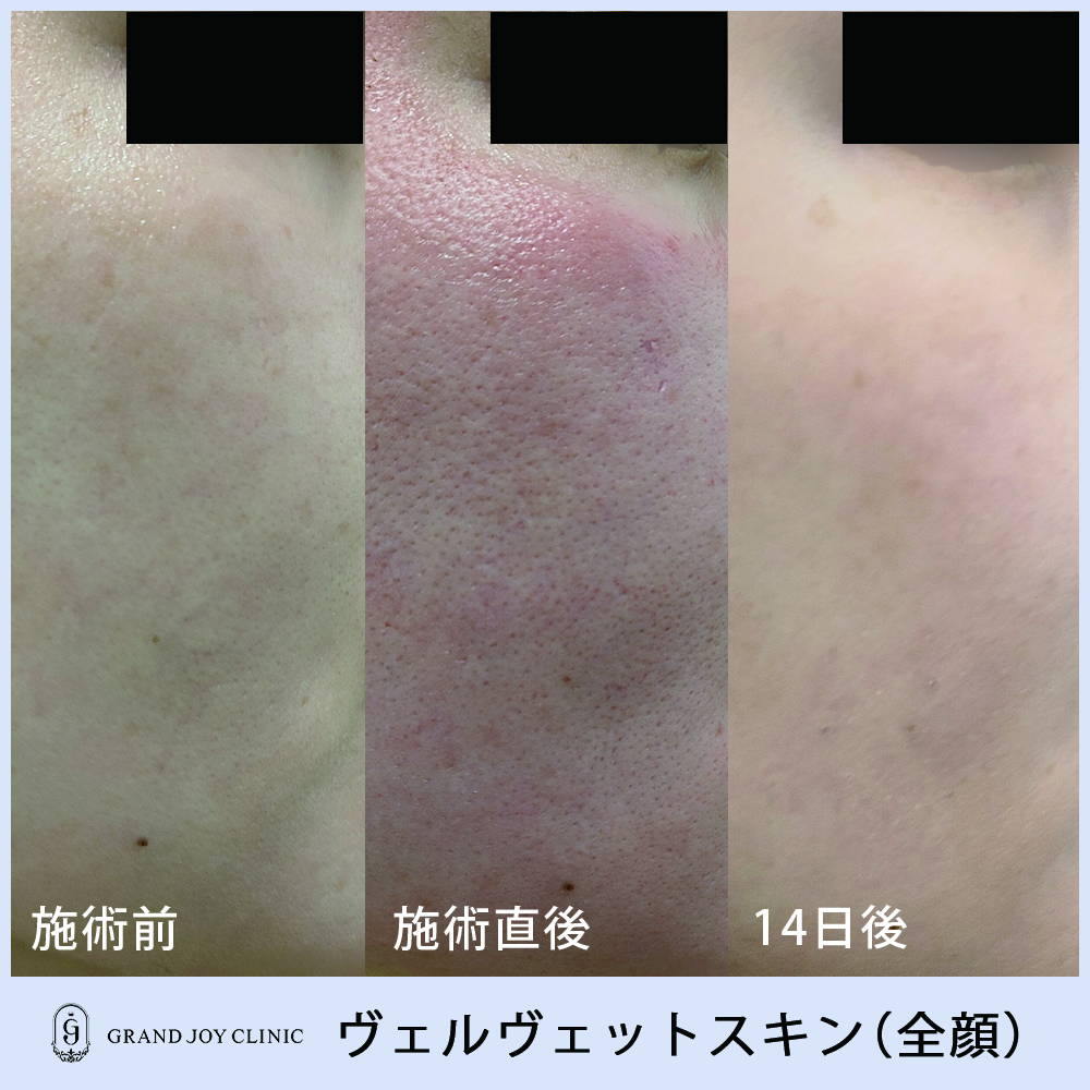 ヴェルベットスキン症例写真1