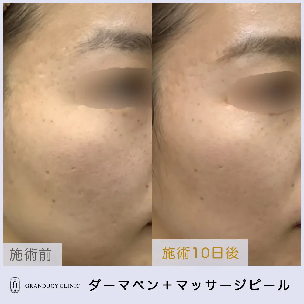 ヴェルベットスキン症例写真2