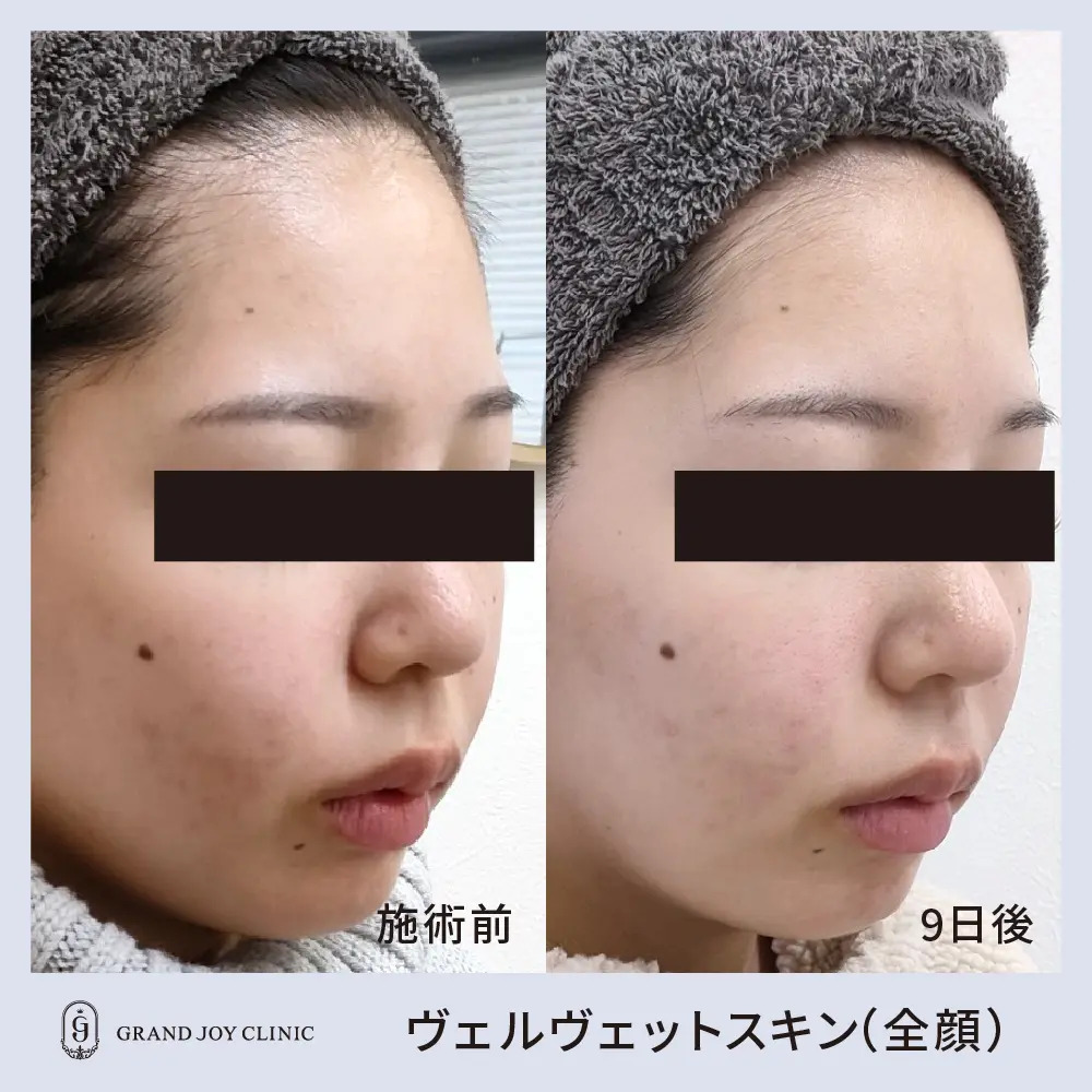 ヴェルベットスキン症例写真3