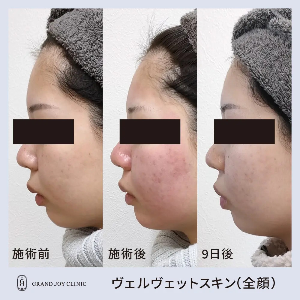 ヴェルベットスキン症例写真4