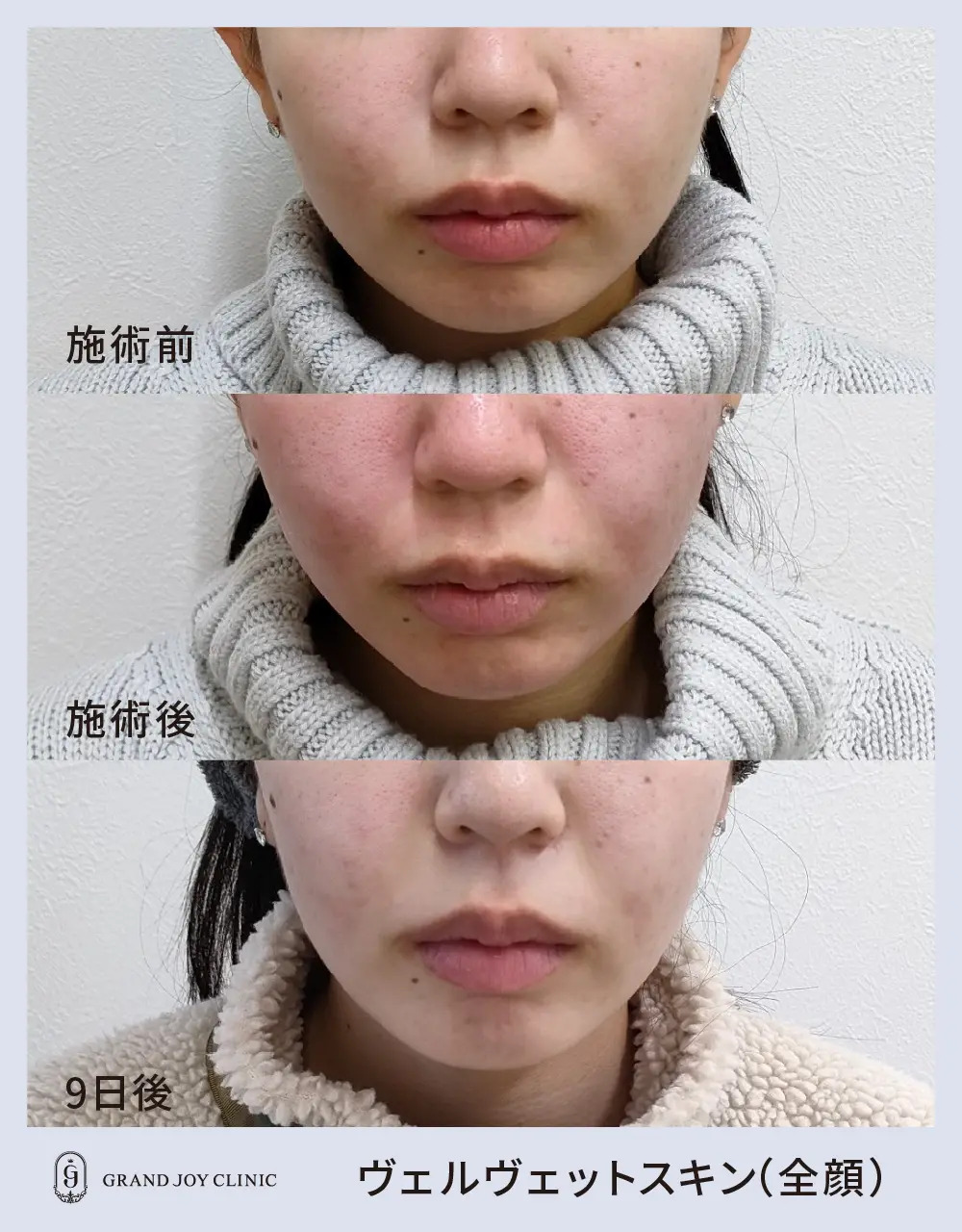ヴェルベットスキン症例写真5